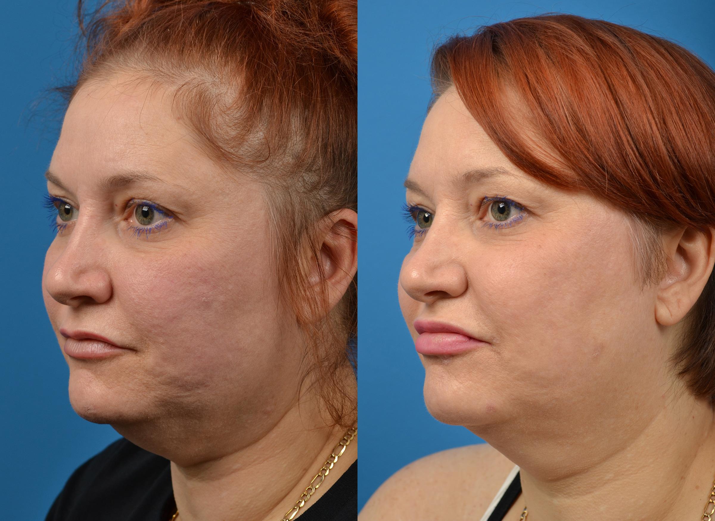 Kybella Photos Melbourne, FL Patient 58553
